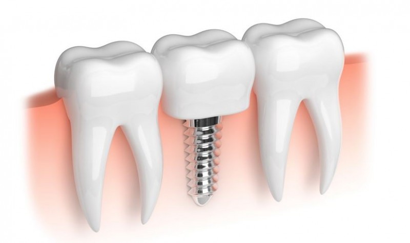 implanty dentystyczne